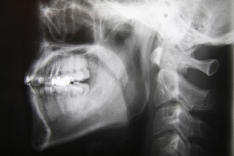 顎関節症のイメージ画像